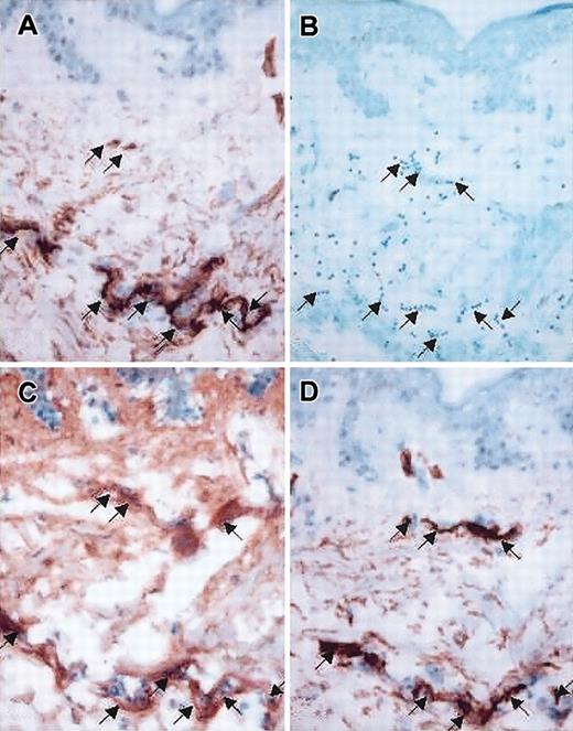 Figure 2. Photomicrographs of sequential sections of skin biopsy from a patient with acute cutaneous GVHD: colocalization of CD34 staining, HA deposition, and lymphocyte adherence. (A,D) Immunohistochemical stain for CD34 antigen, demonstrating location of endothelial structures (original magnification × 20). (B) Adherence assay result, showing lymphocytes (dark blue dots) attaching to dermal papillary structure (methyl green-thionin stain, original magnification × 20). (C) Distribution of HA (original magnification × 20), histochemically identified using a biotinylated bovine HA-binding proteoglycan (bPG); skin sections treated with hyaluronidase (20 U/mL) before incubation with bPG revealed no staining, and incubation of bPG with soluble HA (0.3 mg/mL) before treatment of skin sections also prevented staining, confirming the specificity of bPG for the detection of HA (data not shown). Note the intense staining of HA in defined structures of papillary/upper reticular dermis (C) correlating with staining for vascular endothelial antigen CD34 (A,D) and with the location of adherent lymphocytes (B) within these sequential sections (A-D, arrows).