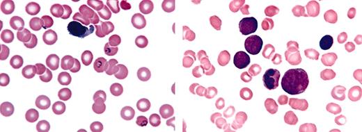 Figure 1. Examples of blood smear photographs transmitted from the peripheral lab to the reference lab. Malaria (left) and acute leukemia (right) are selected. Wright stain was used. Original magnification, × 500.