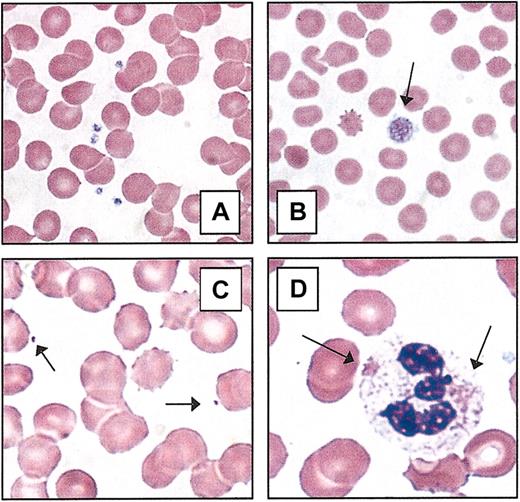 Figure 2. Peripheral blood platelets. (A) Normal blood smear. (B) Macrothrombocyte. The platelet depicted (arrow) is larger than the average erythrocyte. (C) Microthrombocytes (arrows) are typical of those seen in Wiskott-Aldrich syndrome or X-linked thrombocytopenia. (D) Döhle-like bodies in the cytoplasm of neutrophils (arrows) are seen in the May-Hegglin anomaly. All photomicrographs originally made at magnification × 100 (Wright-Giemsa stain).