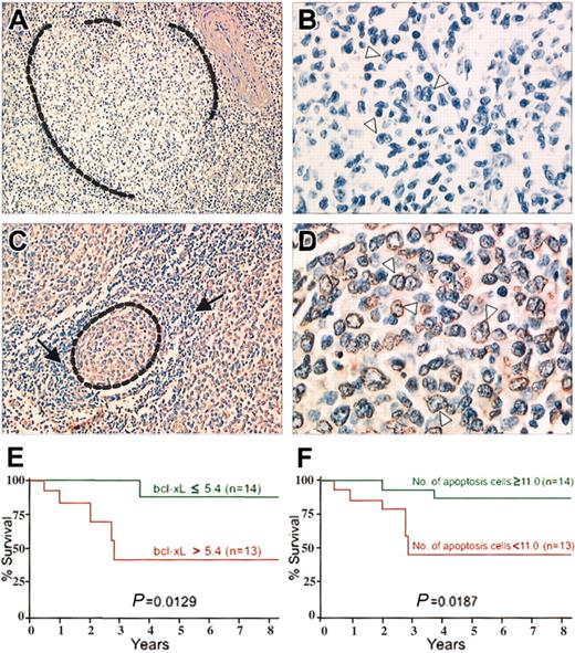 Figure 1. TUNEL assays on 2 follicular lymphoma patients. (A-B) Patient 1. Follicular lymphoma with high level of bcl-xL gene expression. (A) A malignant follicle (surrounded by dotted line) is negative. TUNEL assay; original magnification, × 200. (B) Higher magnification of the malignant follicle. Typical malignant centrocytic cells with cleaved nuclei (arrowheads) are negative. TUNEL assay; original magnification, × 700. (C-D) Patient 2. Follicular lymphoma with low level of bcl-xL gene expression. (C) A malignant follicle (surrounded by dotted line) is composed of cells stained by TUNEL assay, when normal lymphocytes around the follicle (arrows) are negative. TUNEL assay; original magnification, × 300. (D) Higher magnification of the malignant follicle. Typical malignant centrocytic cells, with cleaved nuclei (arrowheads) stained. TUNEL assay; original magnification, × 800. (E) Kaplan-Meier survival curve for patients with follicular lymphoma according to bcl-xL gene expression. Overall survival of the patients with bcl-xL gene levels above the median (red line) was significantly shorter than that of patients with bcl-xL gene levels below and equal to the median (green line). (F) Kaplan-Meier survival curve for patients with follicular lymphoma according to number of apoptotic cells. Overall survival time of patients with fewer apoptotic lymphoma cells than the median (red line) was significantly shorter than that of patients with apoptotic cell numbers equal to or exceeding the median (green line).