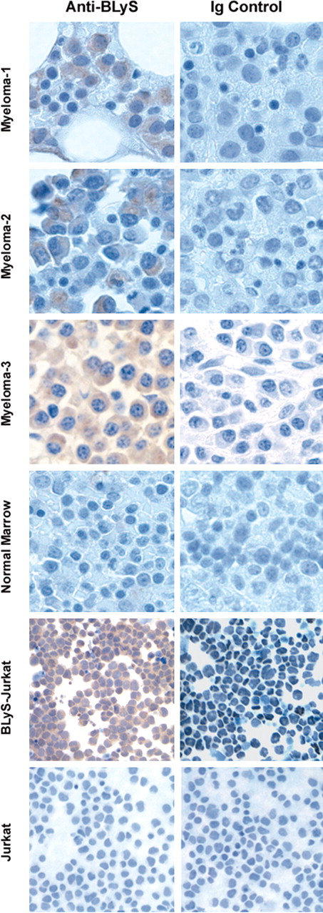 Figure 5. Expression of BLyS in primary myeloma cells. Immunohistochemical analysis of BLyS expression in normal bone marrow, MM bone marrow (MM 1-3), Jurkat, or BLyS-transfected Jurkat cells was performed with the anti-BLyS mAb from R&D Systems as described in “Materials and methods.” These results are representative of 3 normal and 10 MM samples. Original magnification, ×200.