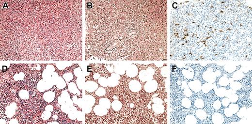 Figure 1. Bone marrow findings in a representative HES patient before and at 1 month following the initiation of imatinib mesylate therapy. (A-C) Before therapy. (D-F) After therapy. Sections were stained with hematoxylin and eosin (A,D), antireticulin antibody (B,E), and antitryptase antibody (C,F). Not only was there a dramatic decrease in eosinophils and myeloid precursors in response to imatinib mesylate (A,D), but a resolution in the hypercellularity (A,D), reticulin fibrosis (B,E), and atypical spindle-shaped mast cells (C,F) evident prior to therapy.
