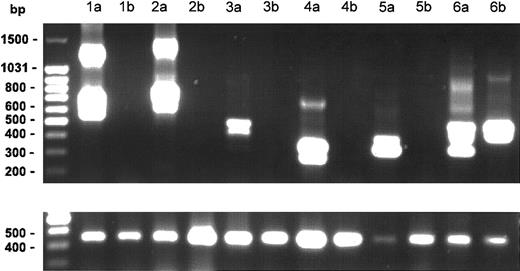 Figure 2. Effect of imatinib mesylate on FIP1L1-PDGFR fusion. Nested RT-PCR results for the FIP1L1/PDGFR fusion gene in PBMC RNA from 6 patients before (lanes a) and after (lanes b) treatment with imatinib mesylate. The lower panel shows the results of RT-PCR for the GAPDH gene as a control for amount of RNA loaded for each patient sample. Various size bands are observed in different cases due to different breakpoints in the FIP1L1 gene as shown previously.1 The different bands in each lane represent splice variants. The FIP1L1-PDGFR fusion became undetectable in 5 of 6 patients after imatinib mesylate therapy.