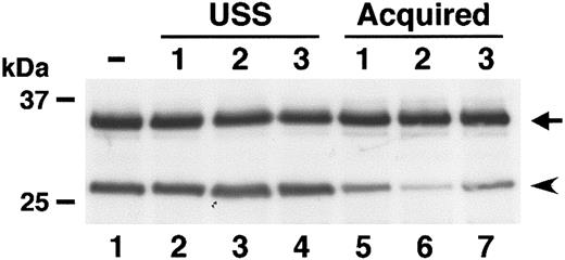 Figure 6. Inhibitory activity of plasma from patients. Normal plasma was preincubated with equal volumes of heat-inactivated plasma from patients with USS (lanes 2-4), Tc-associated TTP (lanes 5-6), and idiopathic TTP (lane 7). Then, cleavage of GST-VWF73-H was compared with normal plasma without preincubation (lane 1). Plasma from patients with acquired TTP but not with USS inhibited substrate cleavage.