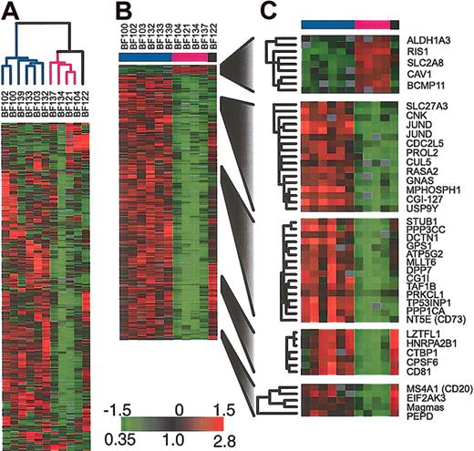 Figure 3. Gene expression patterns in the subset of patients harboring BCR/ABL (A) Agglomerative hierarchical clustering according to similarity in gene expression patterns. The variation in expression is displayed for the 500 clones (463 genes) for which the log2 intensity ratio differed by at least 1.5 from its mean on at least 2 arrays. The broad features of the clustering patterns were robust to variations in gene selection criteria. (B) SAM identifies genes whose expression is statistically different in the 2 groups of BCR/ABL samples (338 clones representing 314 genes, 1000 permutations, median false significant clones = 2.8), (C) selected genes identified by SAM.