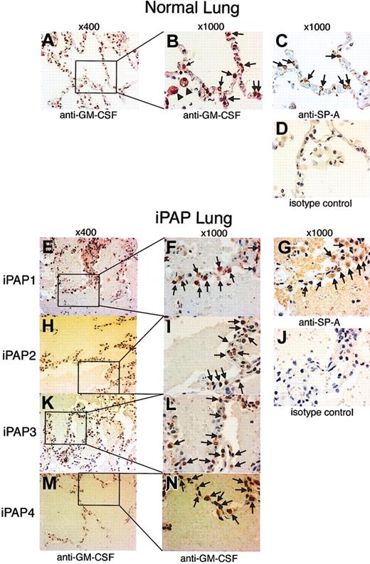 Figure 2. Immunohistochemical detection of GM-CSF in the lungs of patients with iPAP. Lung tissue biopsy specimens from 4 patients with iPAP or 4 healthy controls were assessed for the presence of GM-CSF and SP-A by immunohistochemical staining. (A-D) Sections of normal lung. AM (B, arrowheads) and alveolar epithelial cells (B, arrows) were stained red by anti-GM-CSF antibody (A-B). Alveolar epithelial cells stained by anti-GM-CSF antibodies were stained brown by anti-SP-A antibodies on the serial section (C, arrows). Therefore, they were likely to be alveolar type 2 cells. (E-N) Sections of iPAP lung. Alveolar epithelial cells (F, I, L, N, arrows) stained red. Similar cells were stained brown on the serial section (G, arrows). Original magnifications are indicated above each column.