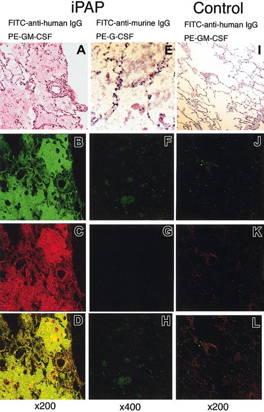 Figure 4. Confocal microscopic images of immunohistochemical double staining for the autoantibodies against GM-CSF. (A-H) Lung tissue from a patient with iPAP. (I-L) Histologically normal lung tissue from a patient with lung cancer. These tissues were stained with hematoxylin-eosin (A, E, I), FITC-conjugated antihuman IgG (green; B, J), FITC-conjugated antimurine IgG (green; F), PE-conjugated GM-CSF (red; C, K), and PE-conjugated G-CSF (red; G). A combination of both channels (B-C, F-G, J-K) clearly demonstrates the occurrence of the autoantibodies in the alveolar filling materials of the iPAP lung (D) but not in normal lung (L).