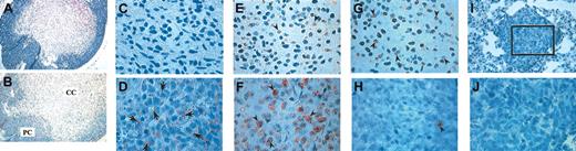 Figure 3. Histologic and immunohistochemical analyses of paraffin-embedded subcutaneous and lung tumors. Tumor sections (5 μ) were either stained with hematoxylin and eosin (H&E) or treated with antibody as described in “Materials and methods.” (A) H&E-stained subcutaneous tumor; (B-D) immunohistochemical detection of TFPI-2 (arrows) in subcutaneous tumors; (E-F) immunohistochemical detection of BrdU-positive cells (arrowheads) in subcutaneous tumors; (G-H) TUNEL staining for apoptotic cells (arrowheads) in subcutaneous tumors; (I-J) anti-TFPI-2 IgG immunohistochemistry of metastatic lung tumors. Boxed area in I is magnified an additional 2.5-fold in panel J. PC indicates peripheral cells (D,F,H). CC indicates core cells (C,E,G). Original magnifications: × 250 (A-B); × 1000 (I); × 2500 (C-H,J).