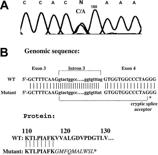 Figure 2. Amplification of a gDNA by PCR using a forward primer in intron 3 and reverse primer in exon 4. (A) A heterozygous point mutation (G>T) was noted in the patient. The tracing shows the reverse strand. (B) Mutational analysis showing a mutation in the splice acceptor site of exon 4 leading to the use of an enforced cryptic splice acceptor site in exon 4 and a frameshift with premature termination in the Runt domain. WT indicates wild type.