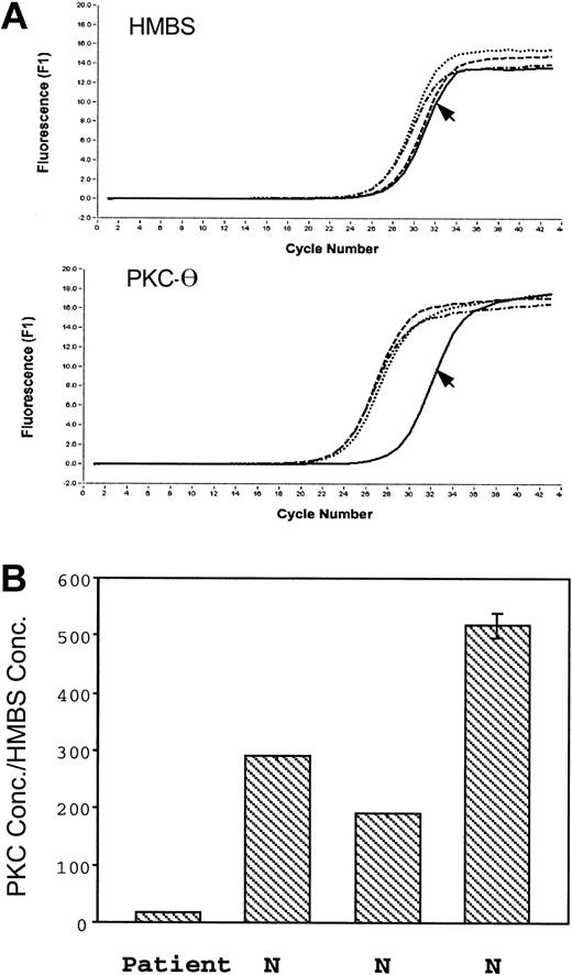Figure 6. Real-time PCR amplification of the HMBS and PKC-θ from platelet RNA. (A) The top tracings show the fluorescence recordings using RNA from the patient (arrow) and 3 control subjects. (B) The bars show the ratio of expression of PKC-θ to that of HMBS in the patient and 3 healthy subjects (N). Shown are results (mean ± SE) of 3 separate experiments.