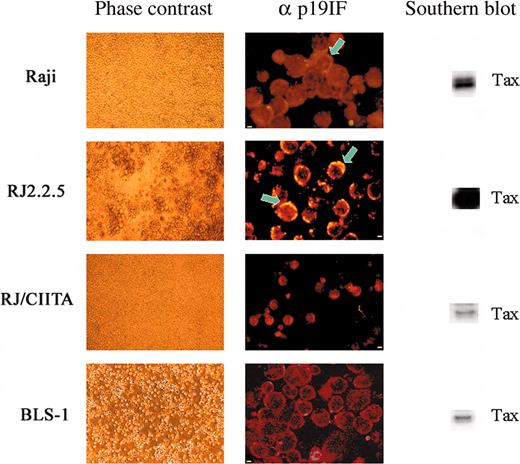 Figure 1. HTLV-2 replication in human B- and T-cell lines. At day 15 after infection, cultured cells were observed in phase contrast microscopy and analyzed for detection of both intracellular HTLV-2 p19 Ag by IIF and tax gene by PCR. Light microscopy showed clear signs of cell lysis for RJ2.2.5 and normal growth for the other cell lines. Cell fluorescence profiles obtained incubating cell cytospins with mAb specific for p19 Ag, followed by rhodamine antimouse IgG, showed an inverse association between IIF positivity and cell viability. Confocal images showed polarization (arrows) of Gag p19-staining (yellow) near the cell membrane in many RJ2.2.5 cells (very strong) and in few Raji cells (weak). The qualitative PCR and Southern blot analysis of tax2 present in 105 cells resulted as a major band in RJ2.2.5 cells. In the other cell lines, the tax signal decreased correlating with the ability of each cell line to support HTLV-2 replication. Scale bar: 2 μm for Raji, RJ2.2.5, and BLS-1; 5 μm for RJ/CIITA.