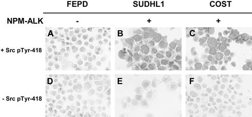Figure 5. Demonstration of Src-kinase activation in ALCL-derived cell lines expressing NPM-ALK by immunocytochemistry. Cytospins from FEPD (A,D), SU-DHL1 (B,E), and COST (C,F) cells were fixed in acetone and immunostained. Src-kinase activation was assessed using a streptavidin-biotin-peroxidase method with anti-Src pTyr418 polyclonal Ab and biotin-conjugated pig antirabbit IgG (A-C). The same protocol without anti-Src pTyr418 polyclonal Ab was performed in order to assess background nonspecific immunostaining (D-F). Original magnification, × 400.