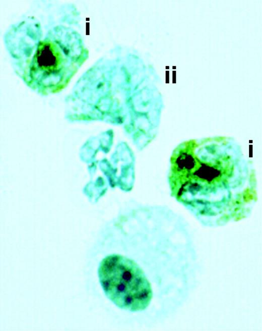 Figure 7. Photograph of immunocytochemical staining for CD34 antigen together with LFB counterstaining on BALf cytospin (× 1000). Dark brown staining indicates positive staining for CD34 antigen, and the green cytoplasmic staining illustrates eosinophilic granulation. CD34+ terminally differentiated eosinophilic cells are marked i, and the CD34– terminally differentiated eosinophil is marked ii.