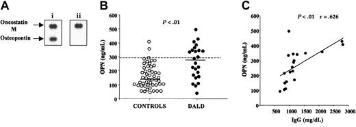 Figure 1. DALD patients display increased serum levels of OPN. (A) Autoradiographs of macroarray membranes hybridized with cDNA from a DALD patient (i) and from her healthy brother (ii). Bottom spots show OPN and top spots show oncostatin M as a control. (B) Serum concentrations of OPN (ng/mL) in 25 DALD patients and 50 healthy unrelated controls. The bold horizontal bars indicate the median values for each group; the dotted line, the 95th percentile of the controls. The P value of differences between patients and controls was calculated using the Mann-Whitney U test. (C) Correlation between OPN and IgG serum levels in DALD patients. The line is the best fitting regression line. The r and P values were evaluated using the Pearson correlation analysis. OPN levels were evaluated by ELISA.