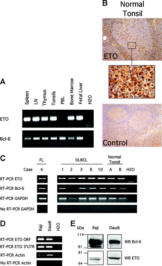 Figure 1. ETO and Bcl-6 are coexpressed in hematopoietic tissues and in normal and malignant B cells. (A) Human tissue cDNA obtained from Clontech (Palo Alto, CA) was used to detect ETO and Bcl-6 by PCR with primers designed to amplify ETO but not ETO-2 or MTGR1. RT-PCR with ETO-specific 3′ UTR primers is shown. (B) Normal human tonsils were submitted to immunohistochemistry for ETO. (Top) Extensive staining for ETO in germinal center and marginal zone lymphocytes (original magnification, × 10). (Middle) × 100 magnification of a section of the germinal center. (Bottom) Rabbit serum control staining (× 10) of tonsil. (C) mRNA was extracted from human FL, human DLBCL, and human normal tonsil and subjected to RT-PCR for ETO or Bcl-6 using primers specific for ETO but not ETO-2 or MTGR1. GAPDH RT-PCR and no-RT-GAPDH PCR reactions were also performed as positive and negative controls, respectively. RT-PCR with ETO-specific 3′ UTR primers is shown. (D) RT-PCR was performed on RNA extract from Raji and Daudi cells. RT-PCR for β actin and no-RT-β actin PCR reactions were also performed as positive and negative controls, respectively. The PCR products were run in 2% agarose gel. RT-PCR with the coding region (ORF) and the 3′UTR ETO-specific primers is shown. (E) Immunoblot of ETO and Bcl-6 was performed on lysates from Daudi and Raji cells with ETO and Bcl-6 polyclonal antibodies.