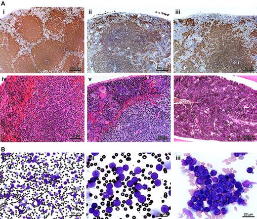 Figure 4. Tg-driven splenic lymphoma and peripheral leukemia. (A) A B220-stained section of asymptomatic Tg spleen (i; bar, 200 μm) is compared with a B220-stained section of a Tg mouse (ii; bar, 100 μm) or Tgmut mouse (iii; bar, 100 μm) with lymphocytic lymphoma. An H&E-stained section of asymptomatic Tg spleen (iv; bar, 50 μm) is compared with an H&E-stained section of a Tg mouse with lymphocytic lymphoma (v; bar, 50 μm). An H&E-stained section of bone marrow of Tgmut mouse with lymphocytic lymphoma is also shown (vi; bar, 100 μm). (B) A Wright-Giemsa–stained smear of peripheral blood of a leukemic mouse that received Tg B-cell lymphoma transplants shows overproliferation of lymphoblasts (i; bar, 50 μm). Blasts exhibit prominent, multiple chromocenters and scanty dark blue cytoplasm (ii; bar, 20 μm). Note the polymorphonuclear granulocyte for comparison. Additional field emphasizes homotypic adhesion and mixed chromatin states (iii; bar, 20 μm).