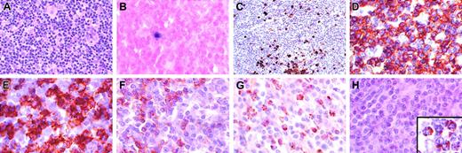 Figure 1. Characterization of T-cell lymphoproliferative process in lymph node. (A) Architecture is diffusely infiltrated by small lymphocytes with admixed histiocytes. (B) In situ hybridization with an EBV-encoded RNA (EBER) probe shows rare positive small lymphocytes (< 1 per high power field) that correspond to the distribution of B cells in the same area. (C) CD20 stain shows scattered small positive lymphocytes and small aggregates, but absence of follicular structures. The majority of the lymphocytes are CD3+ (D), with a predominance of CD8+ cells (E), over CD4+ cells (F). Numerous lymphocytes are granzyme B positive (G), but negative for perforin (antibody KM585-P1-8; Kamiya Biochemical, Seattle, WA) (H). Inset in panel H shows positive perforin control in a patient with large granular lymphocyte leukemia. Original magnification, × 400, except panel C (× 250) and panel H inset (× 1000).