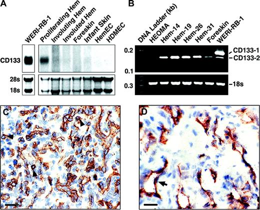Figure 1. CD133-2 and KDR+ immature ECs in proliferating hemangioma. (A) Pooled RNA (5 μg) from proliferating, involuting, or involuted hemangioma tissues, neonatal foreskins, or healthy infant skins and 15 μg RNA from cultured WERI-RB-1, hemangioma-derived ECs (HemEC) or human dermal microvascular ECs (HDMECs) were analyzed by Northern blotting using a 32P-labeled CD133 probe. The blot was exposed for 8 hours (upper left) and 10 days (upper right). RNA levels were verified by ethidium bromide–stained rRNA. (B) CD133-1 and CD133-2 were amplified by RT-PCR from hemangioendothelioma (HEOMA), proliferating hemangiomas designated 14, 19, 26, and 31 from patients 4 to 12 months of age, neonatal foreskin, and WERI-RB-1 retinoblastoma cells. Equivalent mRNA level was indicated by 18s rRNA. Frozen sections of proliferating (C) and involuting (D) hemangioma from patients 5 months and 2 years of age, respectively, were stained with an antihuman KDR mAb and developed with AEC chromagen. Cell nuclei were counterstained with hematoxylin. Interstitial KDR+ cells and examples of flat ECs are indicated by arrowheads and arrow, respectively. Scale bar is 20 μm.