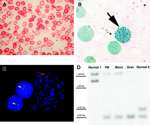 Figure 1. Peripheral blood findings and molecular evidence for loss of the telomeric region of chromosome 16p in a patient with acquired hemoglobin H and myelodysplastic syndrome. (A) Wright-Giemsa–stained peripheral blood smear demonstrates severe anisopoikilocytosis with hypochromic “ghost cells” almost completely devoid of hemoglobin (original magnification × 400). (B) Brilliant cresyl blue stain of peripheral blood reveals a “golf ball” cell (black arrow) with classical HbH inclusions (original magnification × 1000). Such cells represented only 0.11% of anucleate erythrocytes in the patient but were observed on multiple occasions. HbH-containing cells are not present in healthy persons. (C) Metaphase spread and 2 interphase nuclei from the patient's bone marrow hybridized with probe GG1 (green signal) reveals GG1 signal on the normal chromosome 16 only (original magnification, × 1000). Yellow arrowheads indicate the single GG1 signal in interphase, corresponding to the normal chromosome 16 short arm. Red arrow denotes the normal chromosome 16 homologue at metaphase, with paired GG1 signals on sister chromatids. (D) Southern blot of the 3′ hypervariable region in the alpha-globin cluster shows 2 bands for the 2 healthy controls (1 from each allele, corresponding to the normal diploid chromosome 16 short arm). In contrast, the second (upper) band from the patient's sample shows reduced probe hybridization. PB indicates DNA derived from unfractionated peripheral blood; Mono, DNA from the mononuclear cell fraction (predominantly lymphocytes); and Gran, the granulocyte-enriched fraction. The superior band is virtually absent from the patient's granulocyteenriched DNA, corresponding to the loss of an alpha-globin cluster in these cells. However, both bands are present in the mononuclear fraction, which is likely to be enriched for normal cells. In the patient's unfractionated peripheral blood, the superior band is less intense than the corresponding band in the mononuclear fragment, consistent with the expected admixture of clonal and nonclonal cells in unfractionated blood.