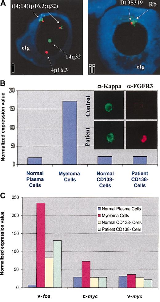 Figure 1. t(4;14) translocation and FGFR3 overexpression in patient MM cells. (Ai) Myeloma cells were evaluated for abnormalities of chromosome 4 and 14; (Aii) chromosome 13 abnormalities were evaluated with 2 probes (D13S319 and Rb) in the 13q14 region, using fluorescent in situ hybridization (original magnification, × 400). cIg indicates cytoplasmic immunoglobulin. (B) Normalized expression values from gene chip Hu95av2 for FGFR3 gene transcripts in CD138+ and CD138– cells from BM from the patient with MM and the healthy twin. MM cells and healthy twin PCs were immunostained with anti-FGFR3 and anti-kappa light chain Abs (inset; original magnification, × 100). (C) Normalized expression values from gene chip Hu95av2 for oncogenes v-fos,c-myc, and v-myc gene transcripts in CD138+ and CD138– cells from BM from the patient with MM and the healthy twin.