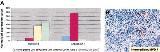 Figure 4. Elevated angiogenesis-related gene expression and increased BM angiogenesis in MM. (A) Normalized expression values from gene chip Hu95av2 for angiogenesis-related IL-8 and angiopoetin-1 gene transcripts in CD138+ and CD138– cells from BM from the patient with MM and the healthy twin. (B) Deparaffinized MM patient BM biopsy specimens from 2002 were immunostained with anti-CD34 Abs using a labeled streptavidin-biotin peroxidase; microvessels per high power field (× 100) and the grade of angiogenesis were evaluated.