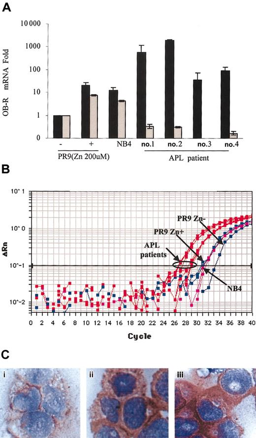 Figure 2. OB-R gene and protein expression in PR9 cells, NB4 cells, and primary APL cells. (A) OB-R long- and short-isoform mRNA levels before and after the induction of PML-RARα (200 μM ZnSO4 treatment) in U937/PR9 cells, in NB4 cells, and in primary APL cells (TaqMan RT-PCR). OB-R mRNA expression of each sample was normalized to β2-microglobulin. PR9 cells without ZnSO4 were used as calibrators (OB-R mRNA level in PR9 cells without ZnSO4 = 1). Percentages of blasts and promyelocytes in APL samples: no. 1, PB, 82%; no. 2, BM, 95%, no. 3, PB, 75%; no. 4, PB, 91% (PB indicates peripheral blood). Graphs represent the mean ± SD of results from 3 different experiments. (B) Amplification plot of OB-R long-isoform cDNA expression in PR9 cells after ZnSO4 treatment in NB4 and primary APL cells. Blue lines indicate PR9; magenta lines, NB4; and red lines, primary APL cells. (C) Representative immunocytochemistry results for OB-R expression in the cytosol of PR9 cells: (i) before ZnSO4 treatment and (ii) after 24 hours of ZnSO4 (200 μM) treatment. (iii) Immunoreaction of OB-R in cytosol of NB4 cells (original magnification, × 200).