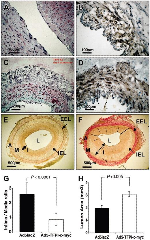 Figure 1. Percutaneous transfection of TFPI inhibits restenosis. Expression of exogenous TFPI detected by immunohistochemistry on days 2 (A-B) and 5 (C-D) after percutaneous transfection with Ad5TFPI–c-myc (1 × 109 pfu/mL) using either the anti-TFPI K2 mAb (A,C) or the anti–c-myc mAb (B,D). Scale bars indicate distance with × 20 (100 μm) and × 10 (200 μm) magnification. Intima (I) to media (M) ratio was determined on Elastica van Gieson–stained vascular sections derived from Ad5TFPI–c-myc– (E) and Ad5lacZ-transfected (F) rabbit femoral arteries by histomorphometric analysis. Internal elastic lamina (IEL) and external elastic lamina (EEL) indicated by arrows (→) delineate adventitia (A), media (M), and intima (I, ↔), which surround the vessel lumen (L). Size bar indicates 500μmat × 4 magnification. Results of I/M ratio (G) and residual lumen area (H) are shown as mean ± SD.