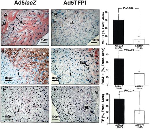 Figure 2. TFPI reduces lesional monocyte recruitment and vascular TF after balloon injury. Immunostaining of MCP-1 (A-B), RAM-11 (C-D), and rabbit TF (E-F) was performed on serial cross sections of Ad5lacZ- and Ad5TFPI-transfected arteries 21 days after balloon injury. Percent fractional area of detected expression is given as mean ± SEM (n = 24) in each group. Arrows (→) indicate the internal elastic lamina (IEL) between neointima (I) and media (M).