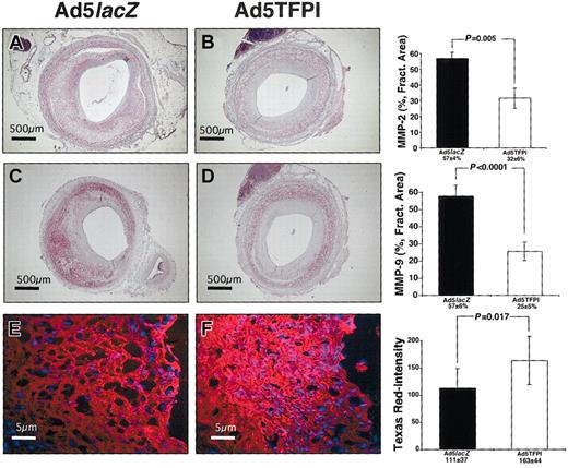 Figure 3. TFPI mediates suppression of vascular gelatinolytic activity after balloon injury. Expression of rabbit MMP-2 (A-B) and rabbit MMP-9 (C-D) in control virus (Ad5lacZ)– and Ad5TFPI-transfected rabbit femoral arteries 21 days after PTA and gene delivery. The size bar indicates 500 μ at × 4 magnification. Percent fractional area is given as mean ± SEM (n = 24) in each group. Gelatinolytic activity of Ad5lacZ-transfected (E) and Ad5TFPI-transfected (F) vessel segments as shown by in situ zymography and quantitated using TissueQuest software. Stains used: Vector VIP Substrate for Peroxidase (A-D); and Texas Red and DAPI (E-F).