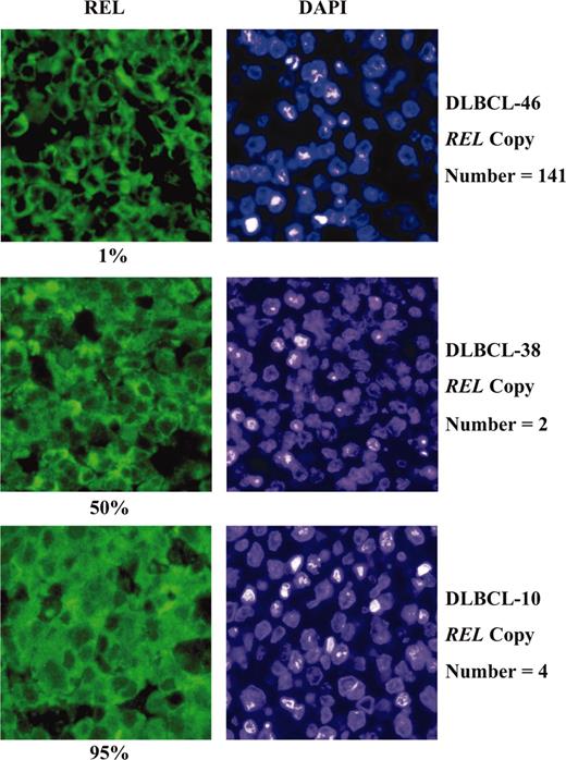 Figure 2. Expression of REL in DLBCL. Nuclear localization of REL was evaluated by immunofluorescence analysis with DLBCL sections counterstained with DAPI for determination of percent positively stained nuclei. Results obtained for 3 representative DLBCL cases are shown with respective percent positive nuclei and REL copy number. Original magnification, × 400.