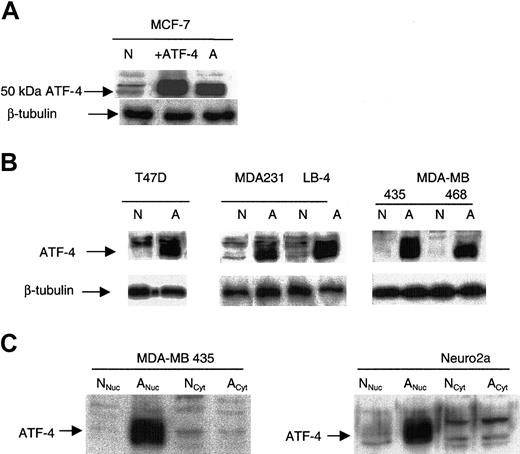 Figure 1. ATF-4 protein is induced in cancer cells under anoxia. (A) ATF-4 overexpression in normoxia (designated as +ATF-4) in MCF-7 cells confirmed the up-regulated band in anoxia to be ATF-4 (50 kDa). (B) Various cancer cell lines, including T47D, MDA-MB 231, 435, 468, and LB-4, were incubated for 16 hours under the corresponding oxygen levels and were analyzed by immunoblot for ATF-4 protein level. N indicates normoxia (21% O2); A, anoxia. (C) MDA-MB 435 and murine N2a cells were incubated for 16 hours in either normoxia or anoxia and were analyzed by immunoblot for ATF-4 protein level in cytoplasmic and nuclear extracts. As indicated, ATF-4 induction in anoxia was only observed in nuclear extracts but not in cytoplasmic extracts. Nuc indicates nuclear; Cyt, cytoplasmic.