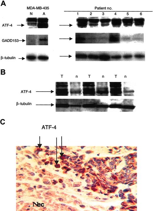 Figure 5. Expression of ATF-4 in primary human breast cancer tumors correlates with that of GADD153, and tumor-section staining indicates ATF-4 expression near necrotic areas. (A) Extracts made from primary malignant human breast tumors were analyzed by immunoblot for ATF-4 and GADD153 protein levels. MDA-MB 435 cells incubated for 16 hours in normoxia or anoxia were used as control. (B) Paired malignant tumor (T)/normal (n) tissue extracts were analyzed using immunoblot for ATF-4 expression. (C) After dewaxing and rehydration, 5-μm sections of metastatic breast tumors were analyzed for ATF-4 expression by immunostaining. Original magnification, × 120.