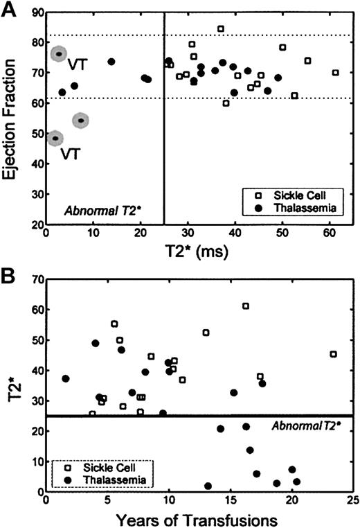 Figure 1. Relationship among LV ejection fraction, myocardial T2*, and transfusion duration. (A) Plot of ejection fraction by MRI versus cardiac T2* in patients with thalassemia (•) and those with SCD (□). Dotted lines represent reference range for ejection fraction.12-14 indicates need for cardiac medications. Two patients had ventricular tachycardia, indicated by the letters VT. (B) Plot of cardiac T2* as a function of transfusion duration. Patients with SCD were predominantly receiving transfusions for less than 13 years (13 of 17), whereas the majority (10 of 19) of patients with thalassemia had transfusions for longer periods. None of the thalassemia patients receiving transfusions for less than 13 years had abnormal cardiac T2*, whereas 8 of 10 patients receiving transfusions for longer periods had abnormal T2*.