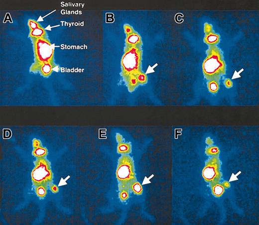 Figure 2. In vivo imaging of myeloma tumor xenografts after MV infection. In panel A, an ARH-77 tumor in a mouse injected intravenously with MV-Edm does not concentrate 123I and gives no signal on the gamma camera 9 days after virus administration. Injection of MV-NIS in mice with MM1 (B), ARH-77 (C), and KAS-6/1 (D-F) tumors led to NIS expression and 123I uptake by the tumors in vivo 9 days after virus administration. Serial imaging of mice with KAS-6/1 tumors on days 3 (D), 9 (E), and 17 (F) after a single injection of MV-NIS shows changes in iodide uptake due to viral and tumor cell replication. All images are adjusted for equal background and were acquired over a 5-minute exposure. The large arrows point to the myeloma tumor xenografts in the right flanks of the mice. Magnification is 0.55 mm per pixel.