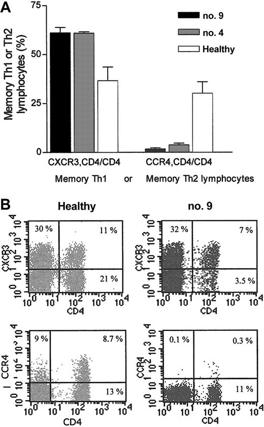 Figure 6. Chemokine receptor expression in CD4 T lymphocytes from XLP patients. (A) Mean ± SEM of the percentage of CXCR3+ or CCR4+ T lymphocytes within the CD4+ subpopulation (memory TH1 or memory TH2 lymphocytes, respectively) in 3 PBMC samples from XLP patients 9 and 4 obtained between November 2002 and April 2003. Shaded area in the graph corresponds to mean ± SEM of healthy control subjects performed simultaneously (n = 7). (B) An example of cytometric analysis (lymphocyte gate) of a healthy control and patient no. 9.