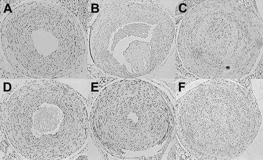 Figure 6. Stasis-induced thrombosis and vascular remodeling in the carotid artery of mutant mice. Representative sections through the ligated carotid artery of mutant mice, obtained 4 weeks after ligation. H&E staining, cell nuclei appear dark. Neointima formation but no thrombosis in wild-type (A) and fibrinogen-deficient (D) mice. Neointima formation and severe thrombosis in thrombomodulin-deficient mice (B-C). Enhanced (E) and in some cases occlusive stenosis/intimal hyperplasia in hyperfibrinogenemic mice (F). Note the absence of organized thrombi in Hifib animals. Original magnification, × 40.