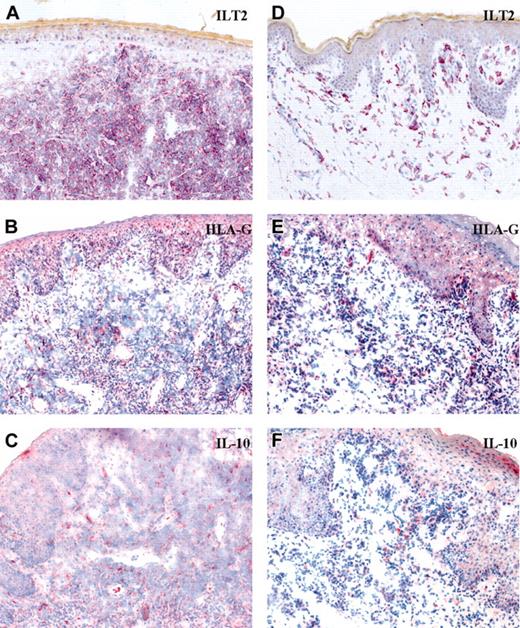 Figure 1. Expression of ILT2, HLA-G, and IL-10 in primary cutaneous T-cell lymphomas. Original magnification, × 20. (A-C) CD56+CD4+ cutaneous cytotoxic lymphoma. (D-F) CD8+ cutaneous cytotoxic lymphoma.