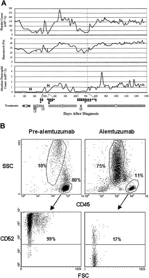 Figure 1. Disease course and immunophenotype of refractory T-LGL before and after alemtuzumab therapy. (A) Data represent all complete blood counts and white blood cell differentials measured from the initial time of diagnosis. Numbered bars represent the mode and duration of treatment modalities as follows: (1) methotrexate 10 mg/m2 twice weekly with prednisone 1 mg/kg (including prednisone taper); (2) cyclosposine 200 mg once a day (days 180-219), 300 mg once a day (days 220-248), and 250 mg once a day (days 249-267); (3) cytoxan 100 mg once a day; (4) ATG 1.5 mg/kg once a day for 4 days; (5) OKT3 20 mg once a day (days 331-339), and 10 mg once a day (days 344-603); (6) pentostatin 4 g/m2 every 2 weeks; (7) alemtuzumab 3 mg to 10 mg to 30 mg within first 3 days of therapy, 30 mg 3 times weekly (days 721-760), weekly (days 766-787), every 2 weeks (days 800-currently/1278). Gray dotted line in each graph represents the beginning of alemtuzumab therapy. • denotes a single packed red blood cell transfusion; ▴, platelet transfusion; and (H) denotes hospitalization for neutropenic fever. (B) Flow cytometry was performed on peripheral blood approximately one week prior to the initiation of alemtuzumab therapy (pre-alemtuzumab) and at approximately 80 weeks into alemtuzumab therapy (alemtuzumab). Cells in all dot plots are gated on mononuclear cells based on forward scatter (FSC) and side scatter (SSC) properties. Cells in lower plots are gated on CD45+ cells as denoted by arrows. Lower quadrants show isotype-matched control antibody staining.