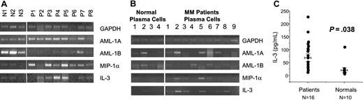 Figure 2. The mRNA expression levels of AML-1A, AML-1B, MIP-1α, and IL-3 in bone marrow samples from patients with MM and healthy donors. Relative mRNA expression levels of AML-1A, AML-1B, MIP-1α, and IL-3 were determined by RT-PCR analysis. (A) (B) Total bone marrow mononuclear cells (A) and CD138+ purified plasma cells (B) from healthy donors and MM patients were examined. The mRNA expression levels of MIP-1α and IL-3 were significantly enhanced in total bone marrow samples (A) as well as purified plasma cells (B) from patients with MM as compared with healthy donors. IL-3 expression levels in purified plasma cells from patients with MM correlated with enhanced MIP-1α and decreased AML-1B expression (r = 0.753 for IL-3 versus MIP-1α; r = 0.62 for IL-3 versus AML-1A). (C) IL-3 protein expression levels in bone marrow plasma from MM patients and healthy donors were measured by commercial ELISA kits. Expression levels of IL-3 were significantly increased in 12 of 16 bone marrow plasma samples from MM patients as compared with healthy donors.