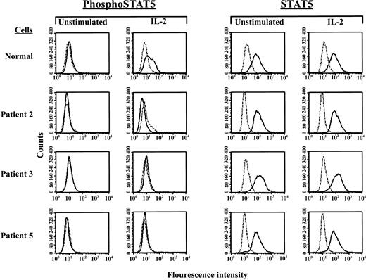 Figure 3. Lack of IL-2–induced STAT5 phosphorylation by SCID patient EBV-transformed B-cell lines. Depicted are 1-color fluorescence histograms of healthy volunteer or SCID patient cells that had been incubated for 20 minutes with or without 1000 U/mL IL-2, fixed and permeabilized, subjected to indirect staining with Ab specific for tyrosine-phosphorylated STAT5 (phosphoSTAT5) or total STAT5 (STAT5), and analyzed by flow cytometry. Dashed lines represent staining with isotype control Ab and FITC-labeled secondary Ab, whereas solid lines signify staining with the indicated anti-STAT Ab and FITC-conjugated secondary reagent.