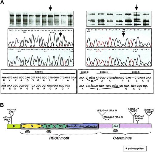 Figure 1. PML mutational analysis in APL. (A) SSCP (top panels) and sequencing analysis (2 middle panels, with the mutated sequences on the upper middle panel) identified 2 DNA sequence variations (arrows) predicted to result in a truncated PML protein (bottom panels) among the 17 APL RA-resistant samples. The first is a small deletion (1272delAG) and the second a splice site mutation (IVS3 - 1G → A). (B) PML missense, truncating, and silent mutations in hematopoietic malignancies. The schematic structure of the PML protein is shown: P indicates proline-rich region; R, RING finger domain; B1 and B2, B-boxes 1 and 2; NLS, nuclear localization signal; M, sumoylation sites. The 1272delAG is indicated as Mut 1 and IVS3 - 1G → A as Mut 2. The polymorphic mutation is also indicated.