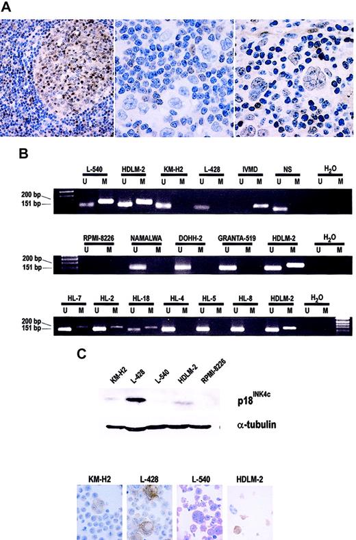 Figure 1. Analysis of p18INK4c protein expression and promoter hypermethylation. (A) Immunohistochemical detection of the p18INK4c protein. In reactive lymphoid tissue (left panel: a benign lymph node), p18INK4c is expressed mainly by lymphocytes in germinal centers and interfollicular plasma cells, but not by mantle cells. Middle and right panels: Examples of HL cases showing absence and presence, respectively, of p18INK4c protein expression by RS cells. (B) MSP analysis of the methylation status of the p18INK4c promoter in HL-derived cell lines (top), NHL-derived cell lines (middle), and HL tumors (bottom). IVMD indicates in vitro–methylated DNA; NS, DNA from a sample of normal spleen, used as a negative (unmethylated) control; U, unmethylated; and M, methylated. (C) p18INK4c protein expression in HL-derived cell lines. Top: Western blot analysis of p18INK4c expression in total protein extracts from the HL cell lines. The multiple myeloma cell line RPMI-8226 shows total absence of p18INK4c expression and was included as a negative control. The expression of α-tubulin was analyzed as a loading control. Bottom: Immunohistochemical staining for p18INK4c on cytospin preparations of the HL-derived cell lines. Original magnification × 1000 for all electron microscopy except left panel of A (× 200).