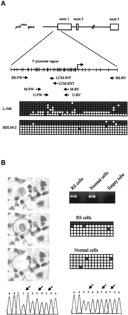 Figure 2. Structure and bisulfite sequencing of the p18INK4c promoter. (A) Top: Genomic structure of the p18INK4c gene. Middle: Distribution of CpG dinucleotides in the promoter region of p18INK4c. Each vertical bar represents a CpG dinucleotide, and the transcription start site is indicated by an arrow. The position of the primer sets used for MSP assays (M-FW, M-RV, U-FW, and U-RV) and bisulfite sequencing (BS-FW and BS-RV for cell lines; BS-FW, LCM-EXT, and LCM-INT for microdissected cells) is also indicated. FW indicates forward; RV, reverse. Bottom: Bisulfite sequencing of the 2 HL-derived cell lines showing p18INK4c promoter hypermethylation (L-540 and HDLM-2). A 483-bp fragment comprising the region immediately upstream of the transcriptional start site and part of exon 1 was amplified and cloned from bisulfite-modified DNA. From each cell line, 6 clones were sequenced. Each row represents 1 clone, and squares represent CpG dinucleotides. Open squares indicate unmethylated CpG sites; gray squares, methylated CpG sites. (B) Bisulfite sequencing of microdissected cell populations. RS and normal cells were isolated by LCM (left). Original magnification × 400. DNA extracted from these cells was treated with sodium bisulfite and used as a template to amplify a 165-bp fragment from thep18INK4c promoter (right), which was cloned and sequenced (5 clones from each reaction are represented as in panel A). Arrows above the electropherograms indicate differences between methylated (bottom, left) and unmethylated (bottom, right) sequences.