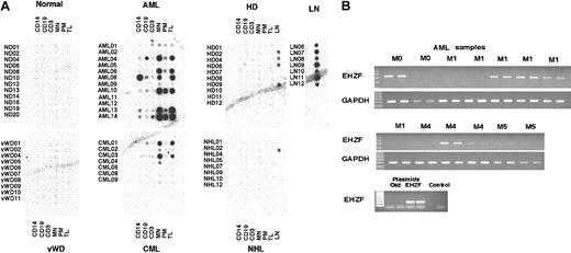 Figure 4. Analysis of EHZF expression in a blood disease profiling array. (A) A radiolabeled probe for EHZF was hybridized to a blood disease profiling array (cat. no. #7842-1; BD Biosciences). The filter was then washed and exposed for 48 hours. Diseases represented on the array are acute myelogenous leukemia (AML), chronic myelogenous leukemia (CML), Hodgkin disease (HD), non-Hodgkin lymphoma (NHL), and von Willebrand disease (VWD). Each sample includes cDNAs from purified monocytes (CD14+), B and T lymphocytes (CD19+ and CD3+, respectively), mononuclear cells (MNs), polymorphonucleates (PNs), and total leukocytes (TLs). Lymph node (LN) samples were from healthy subjects and from HD02, HD04, HD06, HD09, and NHL02 patient samples only. The filter was then later stripped in 0.5% SDS by boiling and the hybridized with a random primer-labeled probe for EBF, which bound only to the cDNAs from CD19+ B lymphocytes. Subsequent stripping and hybridization of the filter with ubiquitin probe confirmed the uniform presence of cDNA in the filter spots. (B) RT-PCR analysis of EHZF expression in acute myelogenous leukemia (AML). cDNA was amplified by PCR in duplicate from AML RNA samples with primers specific for EHZF for 40 cycles or with GAPDH primers for 24 cycles. PCR products were analyzed by 1% agarose gels and ethidium bromide staining. As controls, 1 ng of plasmids pFlag-CS2-OAZ(KIAA0760-L), p3xFlagCMV7.1-EHZF, or buffer containing no plasmid (control) were amplified for 20 cycles.