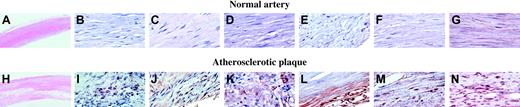 Figure 6. Immunohistochemistry of normal and atherosclerotic tissue. Immunohistochemistry for each of the 3 proteins was performed on sections of arterial tissue from 5 patients with atherosclerosis. The results from one representative patient are shown. Low-power hematoxylin and eosin staining of normal (A) and atherosclerotic plaque (H). Platelet incorporation into the plaques was demonstrated by staining for the platelet-specific proteins PF4 (J) and CD41 (I). Secretogranin III (L) and calumenin (M) were widely expressed in the plaque, whereas vascular smooth muscle cells in the lesion, identified by smooth muscle actin staining (G,N), stained for cyclophilin A (K). No staining for secretogranin III, calumenin, or cyclophilin A was observed in sections of normal artery (B-F). Original magnification × 2.5 (A, H); × 63 (B-G, I-N).