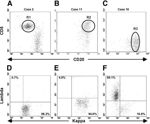 Figure 2. Monoclonal B cells present in the blood of elderly people are phenotypically heterogeneous. Cytofluorimetric analyses of whole blood from 3 patients carrying either a classic CLL-like (A,D), or an atypical CLL-like (B,E), or a non–CLL-like (C,F) B-cell clone are presented. (A-C) Dot plots were obtained by gating lymphocytes (identified on side-scatter and forward-scatter profiles) expressing CD19. The intensity of CD20 and CD5 is shown on the x-axis and y-axis, respectively. R1, R2, and R3 gates indicate the clones. (D-F) Dot plots show κ and λ light chain expression of the B-cell clones as identified on panels A, B, and C.