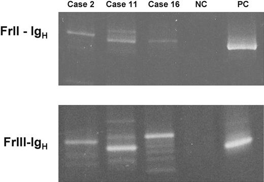 Figure 3. PCR analysis confirms the presence of monoclonal IgH rearrangements. Two seminested PCR reactions were performed to detect FrII-IgH and FrIII-IgH rearrangements on genomic DNA. PB DNA was obtained from 3 cases carrying a classic CLL-like (case 2), an atypical CLL-like (case 11), and a non–CLL-like (case 16) monoclonal B-cell population. PCR products have been visualized under transillumination after separation onto 10% (for FrII-IgH) and 15% polyacrylamide gels (for FrIII-IgH). NC and PC indicate negative and positive control (MEC-1 B-cell line30).