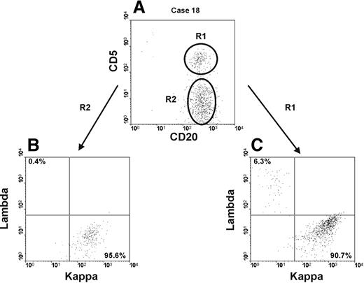 Figure 4. Two distinct B-cell clones can coexist in the same blood sample. Cytofluorimetric analyses of whole blood from one individual (case 18) carrying 2 distinct B-cell clones is presented. (A) Dot plot was obtained by gating lymphocytes (identified on SSC and FSC profiles) expressing CD19. The intensity of CD20 and CD5 is shown on the x-axis and y-axis, respectively. R1 and R2 identify an atypical CLL-like clone and a non–CLL-like clone, respectively. (B-C) Dot plots show κ and λ light chain expression, on the x-axis and y-axis, respectively, of the atypical CLL-like clone (R1) in panel B and of the non–CLL-like clone (R2) in panel C.