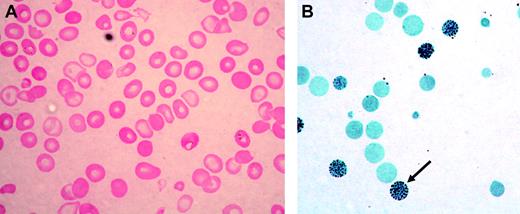 Figure 1. ATMDS peripheral blood findings. (A) Peripheral blood smear (hematoxylin-eosin; original magnification, × 400) from ATMDS patient no. 12 (Table 1) demonstrates a typical dimorphic red cell picture with severe hypochromia, microcytosis, and occasional poorly hemoglobinized “ghost cells.” (B) A hemoglobin H preparation (brilliant cresyl blue; original magnification, × 400) from patient no. 4 at time point 1 reveals many classic “golf ball cells” (arrow) with intracellular hemoglobin H inclusions.