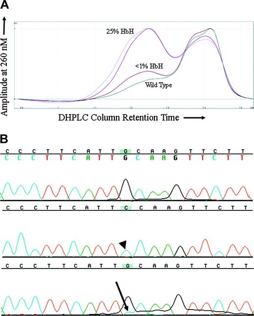 Figure 3. 576G>C ATRX mutation in a patient with ATMDS. (A) DHPLC tracing of the exon 8 amplicon from patient no. 4. The lighter and darker purple tracings represent unfractionated peripheral blood and bone marrow from a sample obtained when the patient had 50% erythrocytes with HbH inclusions by brilliant cresyl blue (BCB) staining and 25% HbH on electrophoresis. The brick red tracing represents unfractionated marrow from a time point 6 months later when the amount of HbH by electrophoresis had fallen to less than 1% and only rare HbH inclusions were detectable on supravital staining. The dark green tracing is a wild-type control. (B) Big Dye–generated sequence of 2 subclones (top 2 lines) and unfractionated marrow DNA (bottom line) from patient no. 4, exon 8 (coding strand 5′ to 3′, running left to right). The top line is sequence of a subclone with normal DNA (ie, 576G), the middle line is from one of the subclones demonstrating the 576G>C mutation (arrowhead), and the bottom line represents DNA from unfractionated marrow where a contribution from cytidine (blue, with arrow) can be seen as a minor peak under the primary fluorochrome representing guanidine (black).